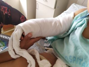 Hospital de Rioja evito pérdida de brazo de niño por picadura de serpiente procedente de Awajún